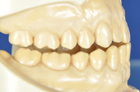 抗菌性手づくりマウスピース製作手順：噛みしめる時の正しい歯の位置