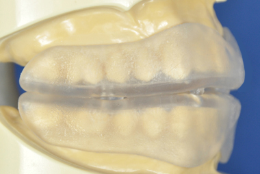 抗菌性マウスピース模型歯型に装着例側面
